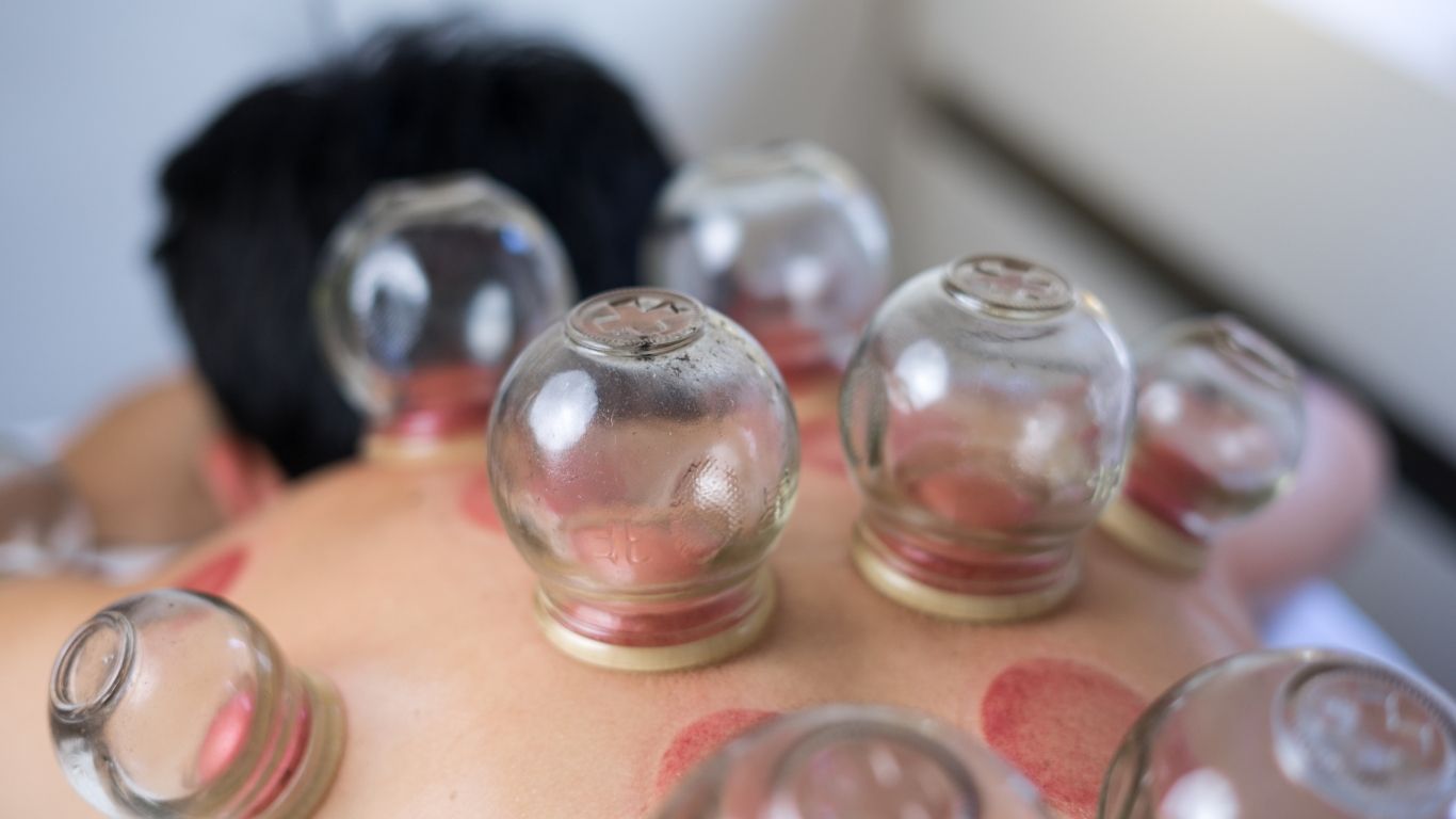 Cupping Therapy Cost