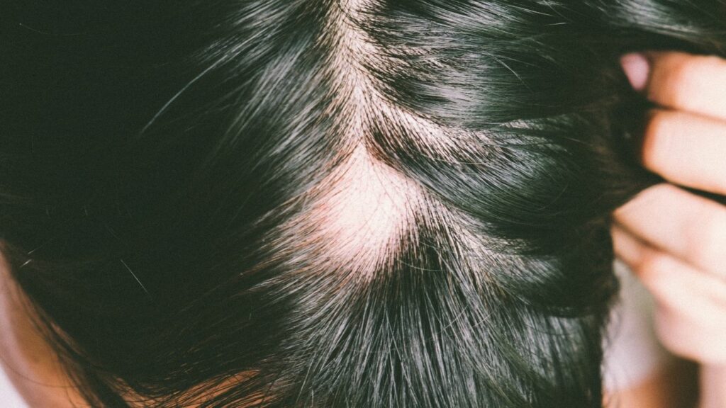 Hijama for Alopecia