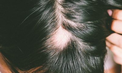 Hijama for Alopecia